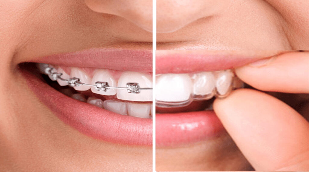 brackets y ortodoncia invisible